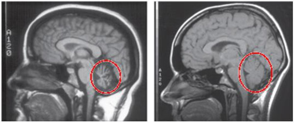 Ảnh chụp tiểu não của người bình thường và người mắc hội chứng tiểu não